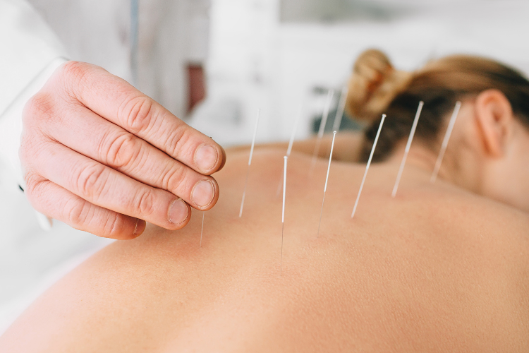 Doctor applying acupuncture needles to a woman's back